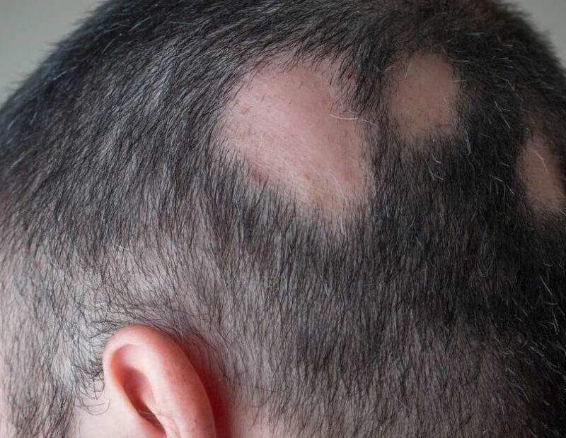 Everything You Should Know About Alopecia Areata