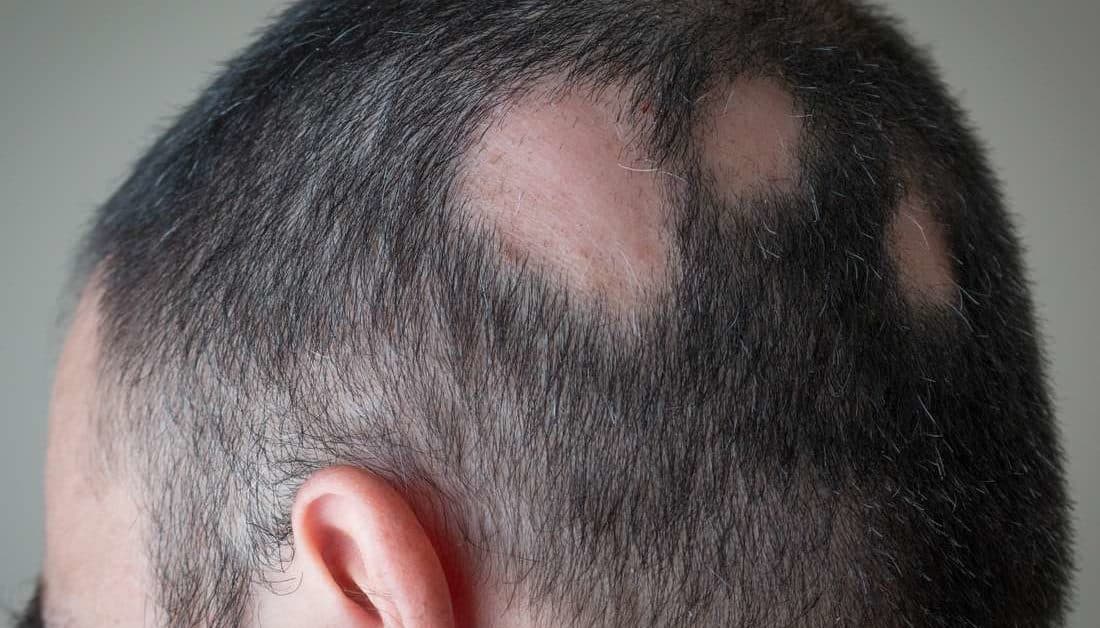 Everything You Should Know About Alopecia Areata